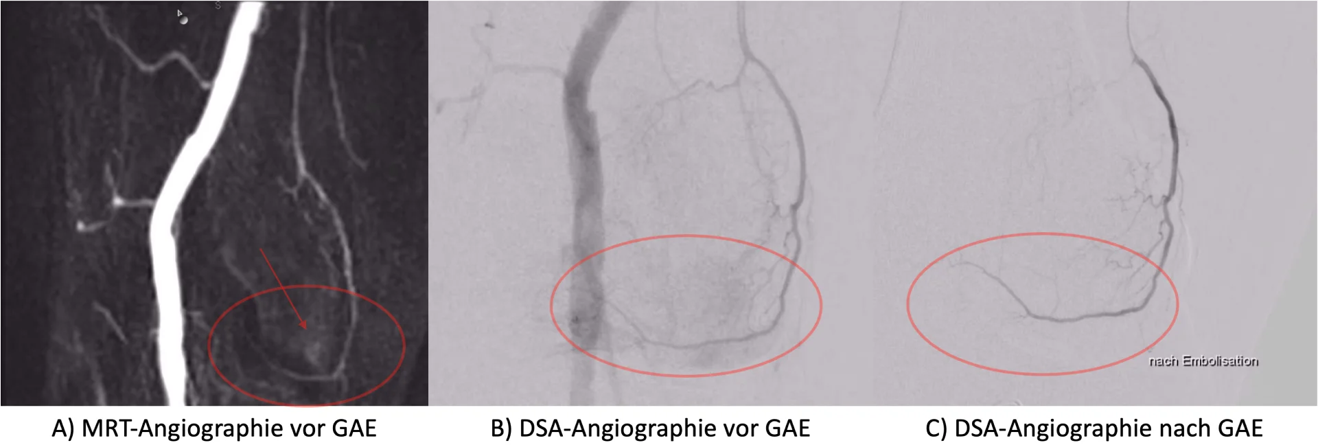 A) Präinterventionelle MRT-Angiographie und B) DSA-Angiographie mit früher Mehrdurchblutung (roter Kreis und Pfeil) als Zeichen einer Entzündung der Gelenkkapsel C). Nach erfolgreicher Embolisation mit kleinen Partikeln kein Nachweis der wolkigen Mehrdurchblutung.