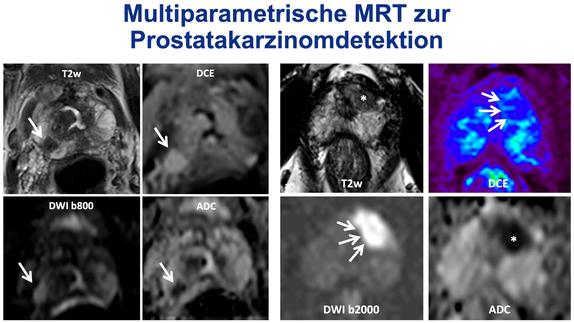 MRT der Prostata eines 65-jährigen Patenten mit T2-Wichtung, Diffusion (DWI, ADC) und Perfusion (DCE), Tumorsuspekte Läsion mit Pfeilen markiert