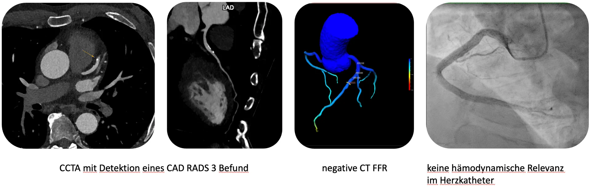 Cardio-CT: Ausschluss einer hämodynamisch relevanten Stenose bei einem CAD RADS 3-Befund.