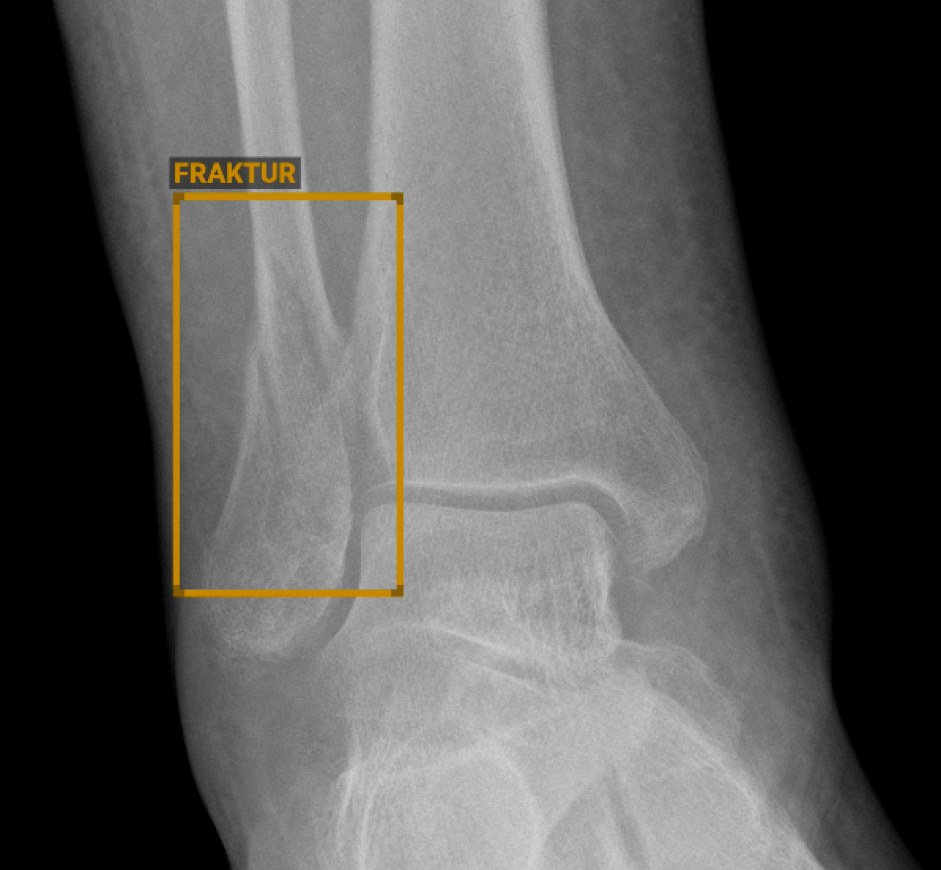 KI-gestützte Frakturerkennung